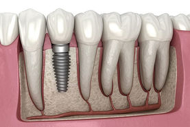 کاشت ایمپلنت دندان؛ بهترین روش جایگزین دندان از دست رفته