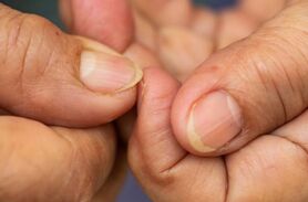 این علائم روی ناخونتان یعنی دیابت دارید